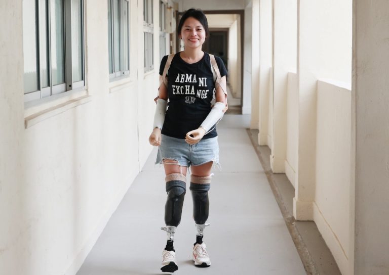 ‘I look forward to going back to work’: Woman happy with new prosthetic arms after losing limbs to infection , Singapore News