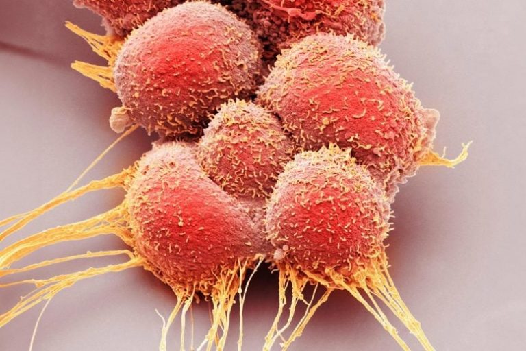 Scientists Discover Key to Stopping Aggressive Prostate Cancer Subtype